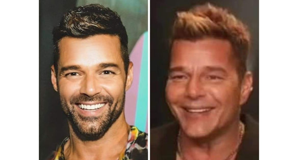 ricky martin face botox surgery